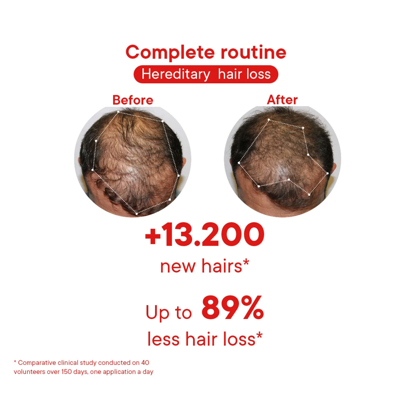 Before and after comparison of hereditary hair loss treatment with text indicating new hair count and reduction percentage.